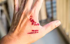 Bị chó cắn, việc đơn giản này có thể cứu sống bạn