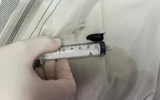 Ho kéo dài suốt 2 năm, đi khám phát hiện hạt hồng xiêm trong phổi