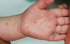 Hà Nội: Sốt xuất huyết tăng nhẹ, tay chân miệng tiếp tục gia tăng